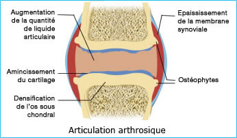 Schéma d'une articulation arthrosique