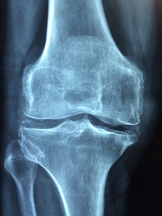 Reconnaître et soulager l&rsquo;arthrose